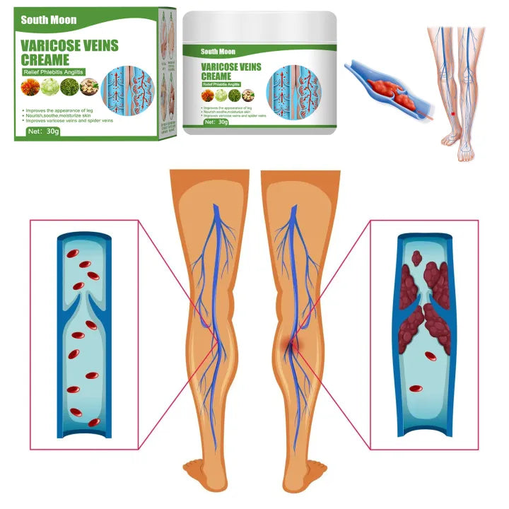 South Moon Varicose Vein Cream ( BUY 1 GET 1 FREE )