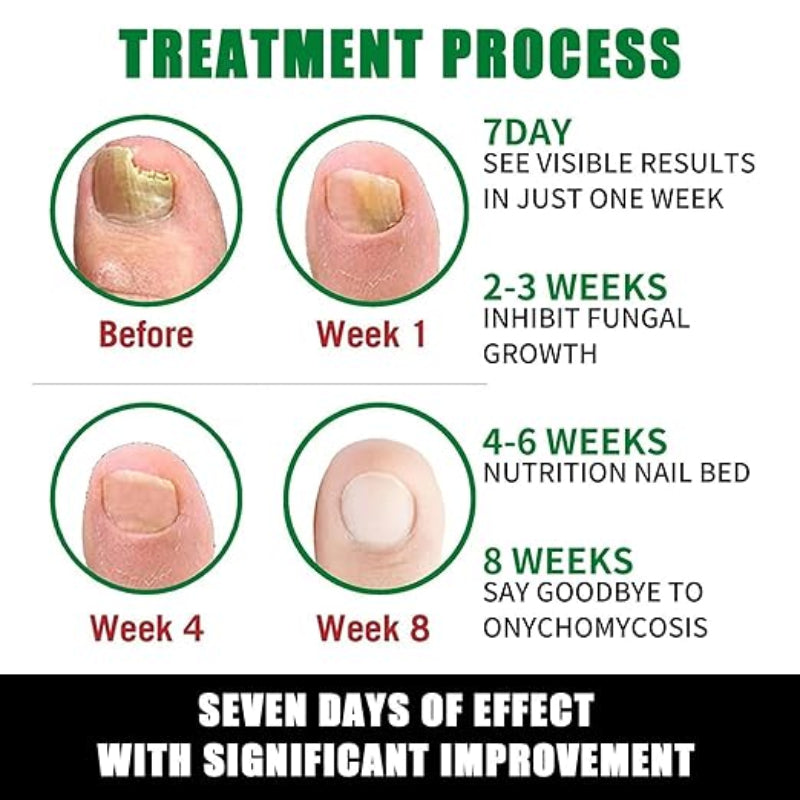 7 Days Nails Fungus Treatment Serum ( BUY 1 GET 1 FREE )