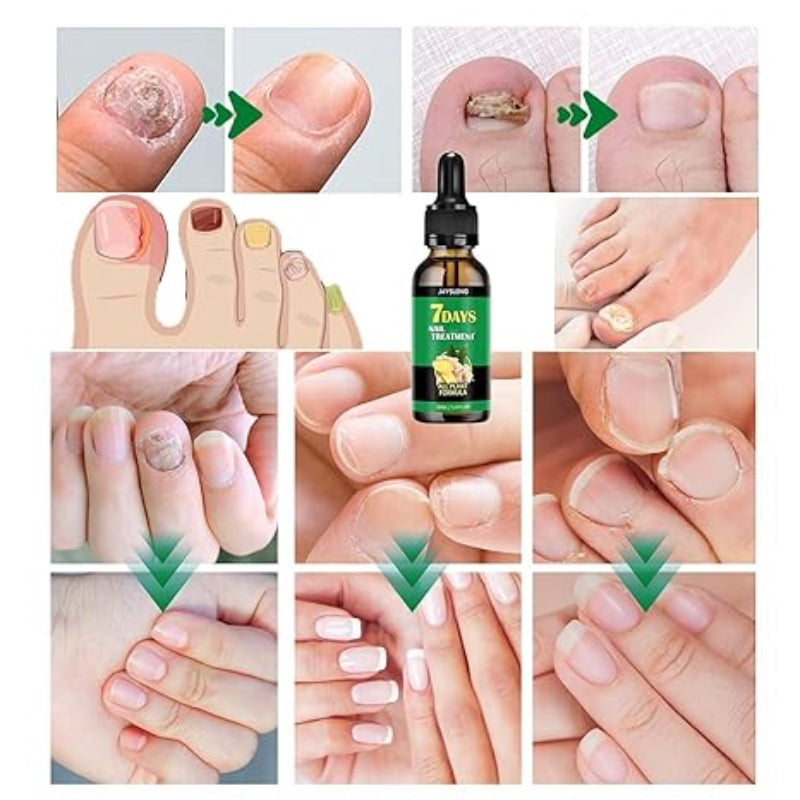 7 Days Nails Fungus Treatment Serum ( BUY 1 GET 1 FREE )