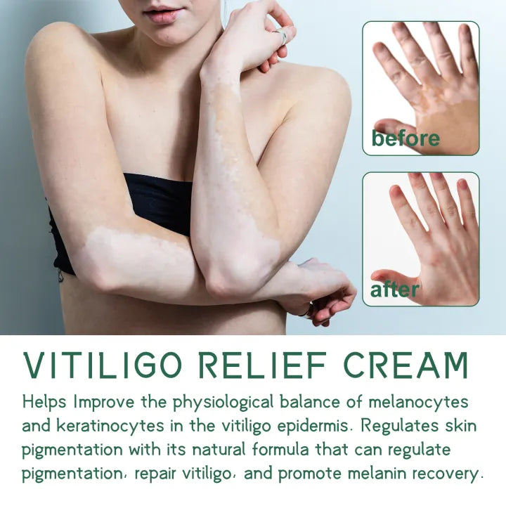 South Moon Vitiligo Relief Cream ( BUY 1 GET 1 FREE )