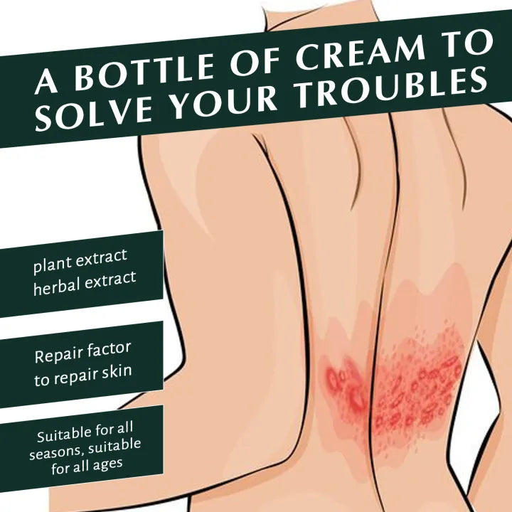 South Moon Psoriasis Cream ( BUY 1 GET 1 FREE )