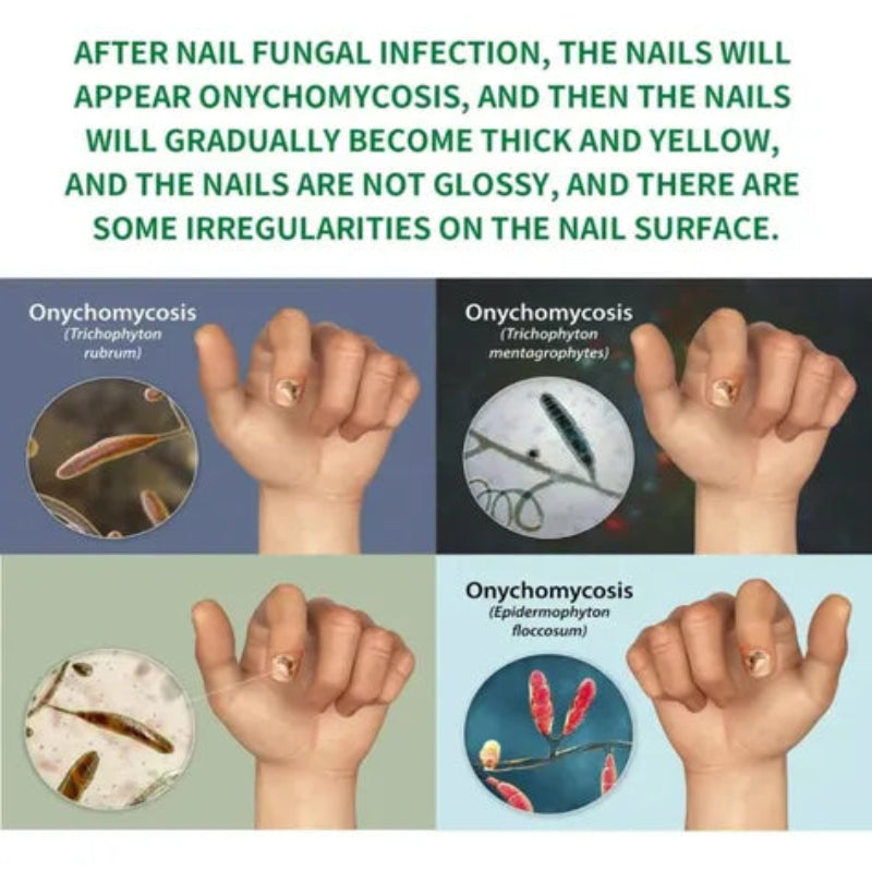 7 Days Nails Fungus Treatment Serum ( BUY 1 GET 1 FREE )