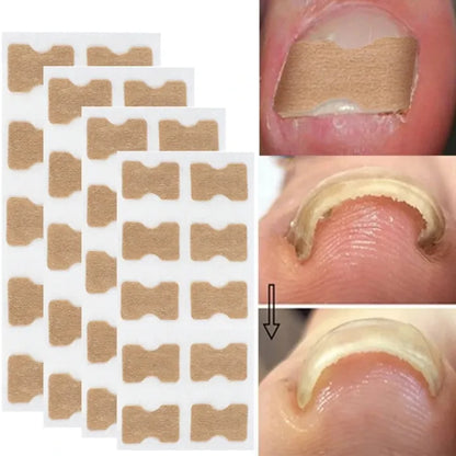 Jaysuing Paronychia Relief Patch ( BUY 1 GET 1 FREE )