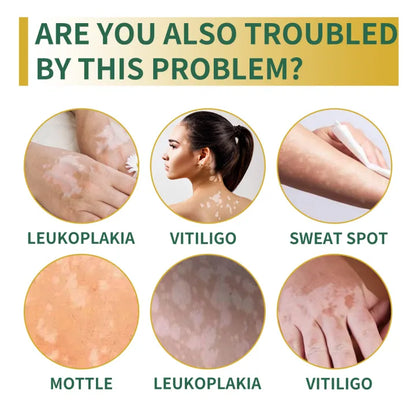 South Moon Vitiligo Relief Cream ( BUY 1 GET 1 FREE )