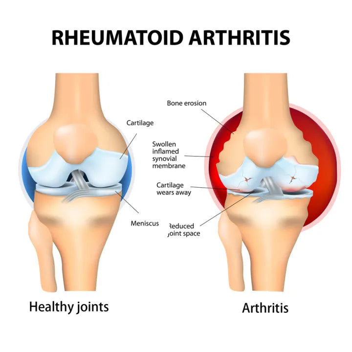 SouthMoon™  Shoulder Joint Paint Relief cream ( BUY 1 GET 1 FREE )