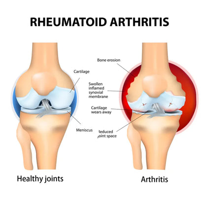 SouthMoon™  Shoulder Joint Paint Relief cream ( BUY 1 GET 1 FREE )