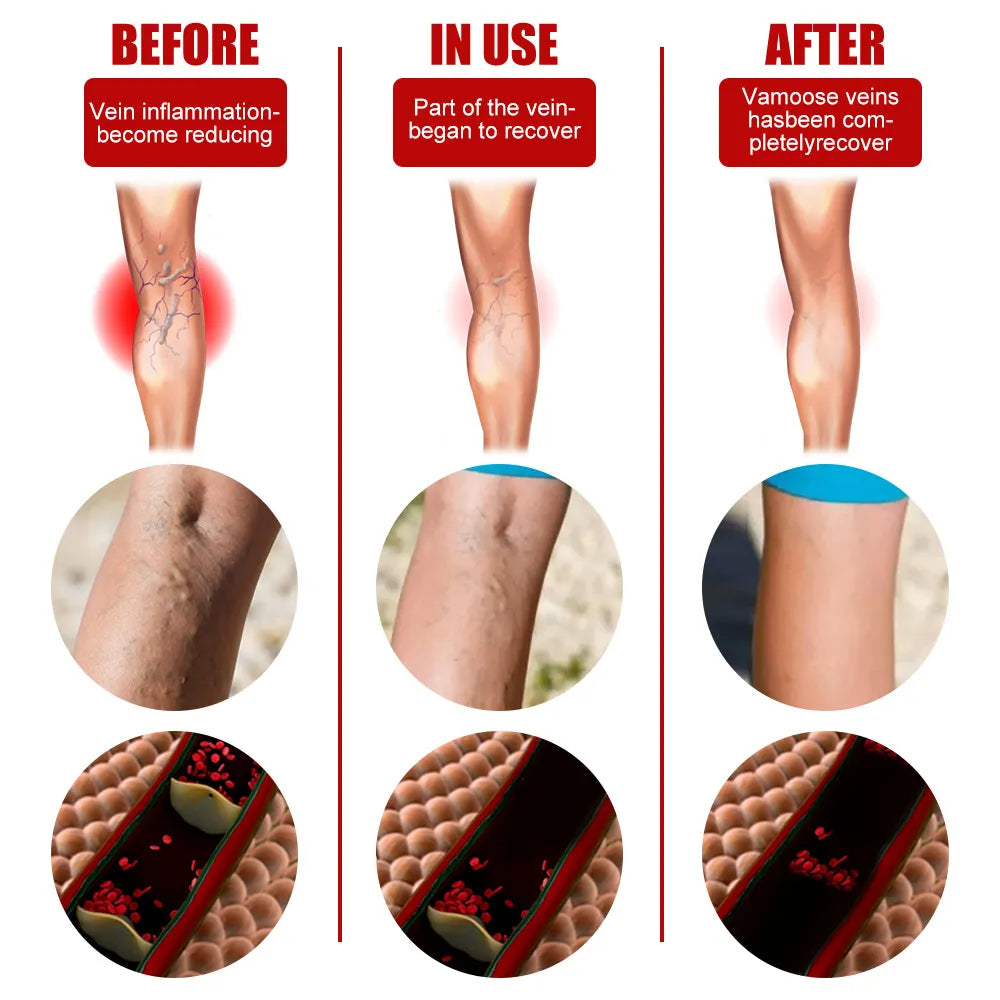 Eelhoe™ Varicose Veins Patches ( BUY 1 GET 1 FREE )