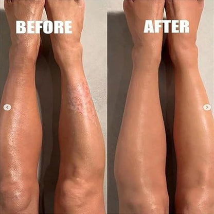 South Moon Psoriasis Moisturizing Cream ( BUY 1 GET 1 FREE )