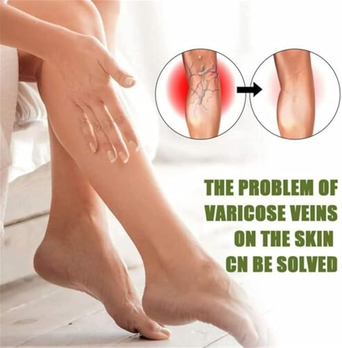 EELHOE™ Ginger Varicose Veins Treatment Soap ( BUY 1 GET 1 FREE )