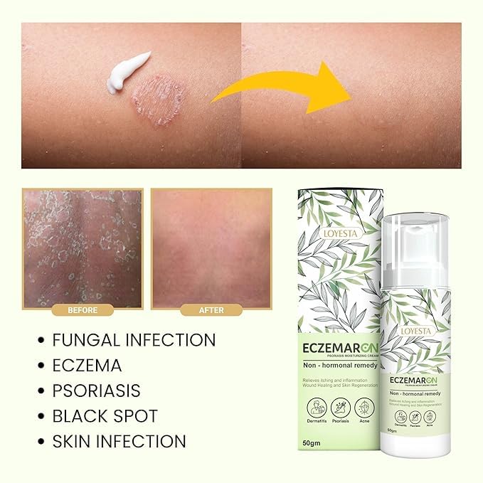 South Moon Psoriasis Moisturizing Cream ( BUY 1 GET 1 FREE )