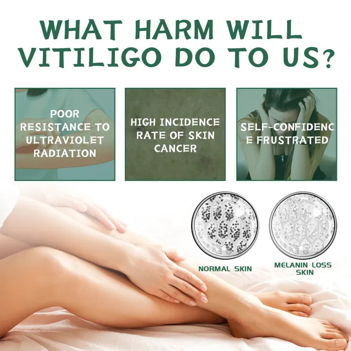 South Moon Vitiligo Relief Cream ( BUY 1 GET 1 FREE )