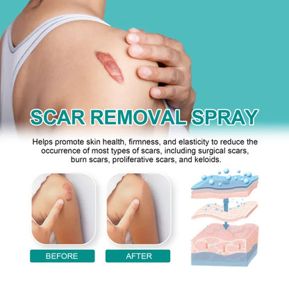 ✨ South Moon™ Medical-Grade Scar Spray( BUY 1 GET 1 FREE )