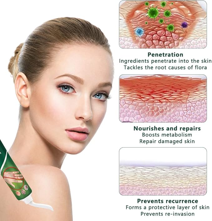 South Moon Psoriasis Cream ( BUY 1 GET 1 FREE )