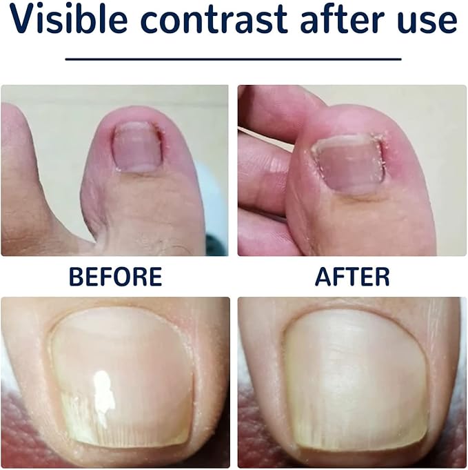EELHOE™ Toe Nail Correction Patch