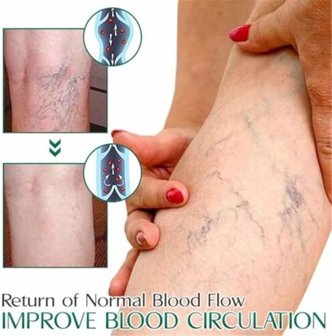 EELHOE™ Ginger Varicose Veins Treatment Soap ( BUY 1 GET 1 FREE )