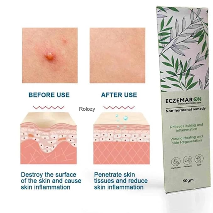 South Moon Psoriasis Moisturizing Cream ( BUY 1 GET 1 FREE )