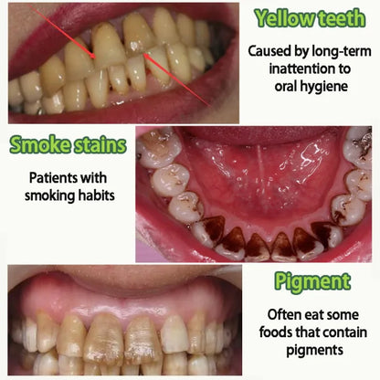 LYDIMOON Whitening toothpaste ( BUY 1 GET 1 FREE )