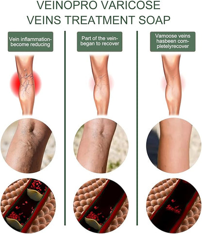 EELHOE™ Ginger Varicose Veins Treatment Soap ( BUY 1 GET 1 FREE )