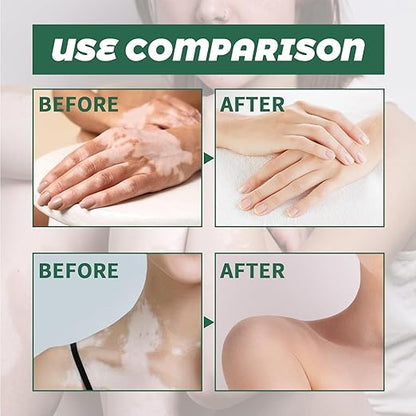 South Moon Vitiligo Relief Cream ( BUY 1 GET 1 FREE )