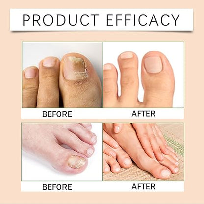 Timilk® FungiBee Advanced Nail Repair Spray