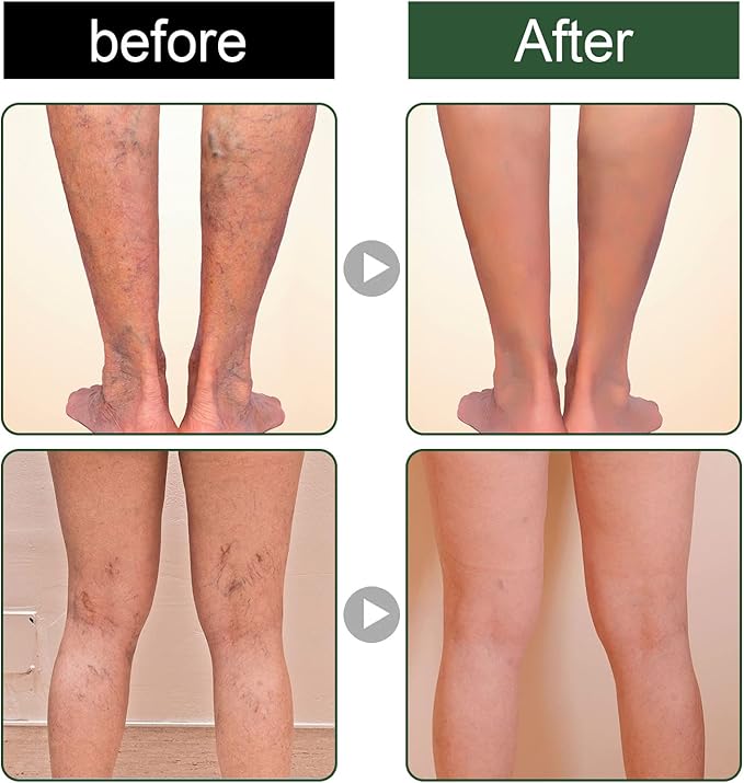 EELHOE™ Ginger Varicose Veins Treatment Soap ( BUY 1 GET 1 FREE )
