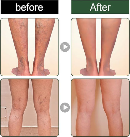 EELHOE™ Ginger Varicose Veins Treatment Soap ( BUY 1 GET 1 FREE )