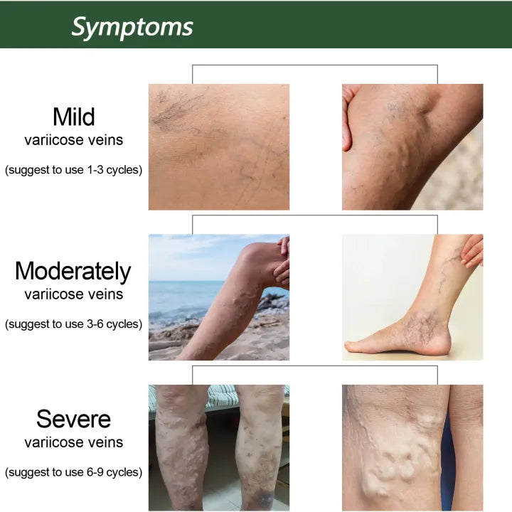 EELHOE™ Ginger Varicose Veins Treatment Soap ( BUY 1 GET 1 FREE )