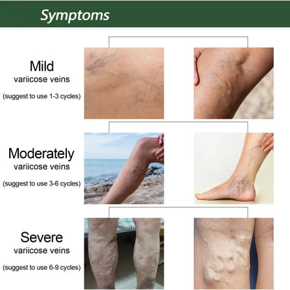 EELHOE™ Ginger Varicose Veins Treatment Soap ( BUY 1 GET 1 FREE )