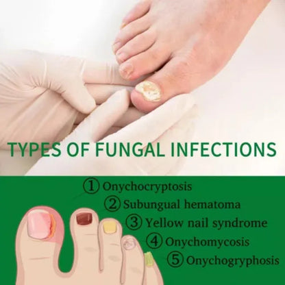7 Days Nails Fungus Treatment Serum ( BUY 1 GET 1 FREE )