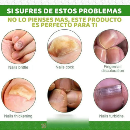 South Moon Anti-fungal Nail Repair Serum Kit