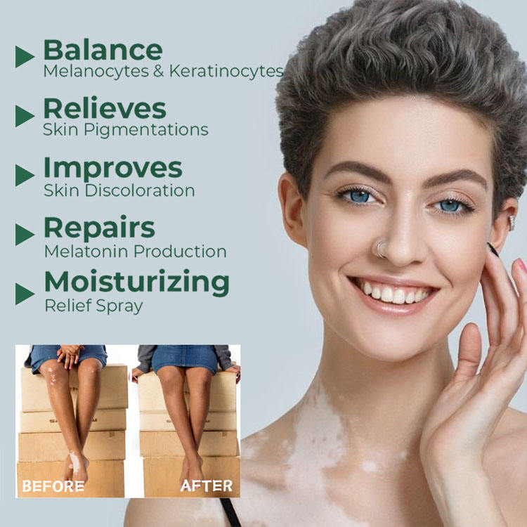 South Moon Vitiligo Relief Cream ( BUY 1 GET 1 FREE )