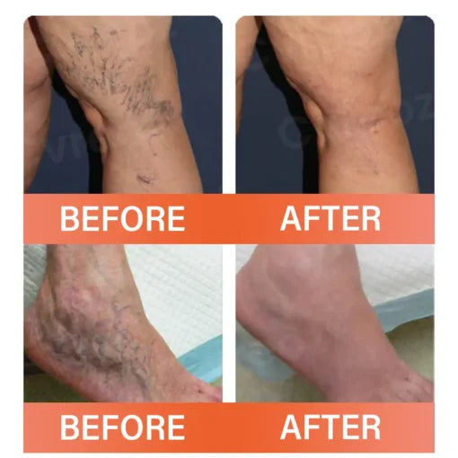 VeinEase™ Varicose Vein Microneedle Patch ( BUY 1 GET 1 FREE )