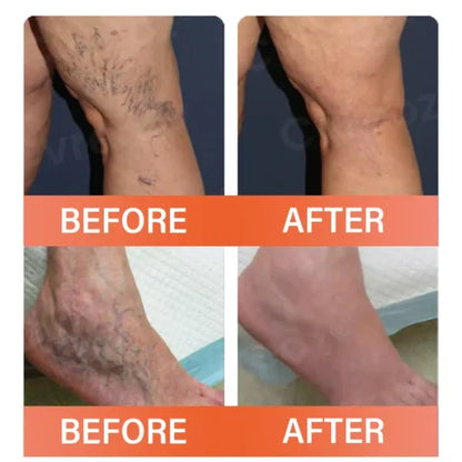 VeinEase™ Varicose Vein Microneedle Patch ( BUY 1 GET 1 FREE )