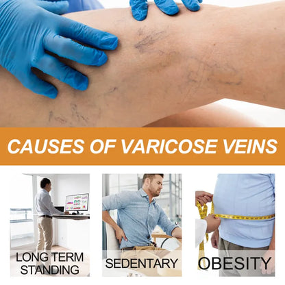 South Moon Varicose Veins Remover Cream ( BUY 1 GET 1 FREE )