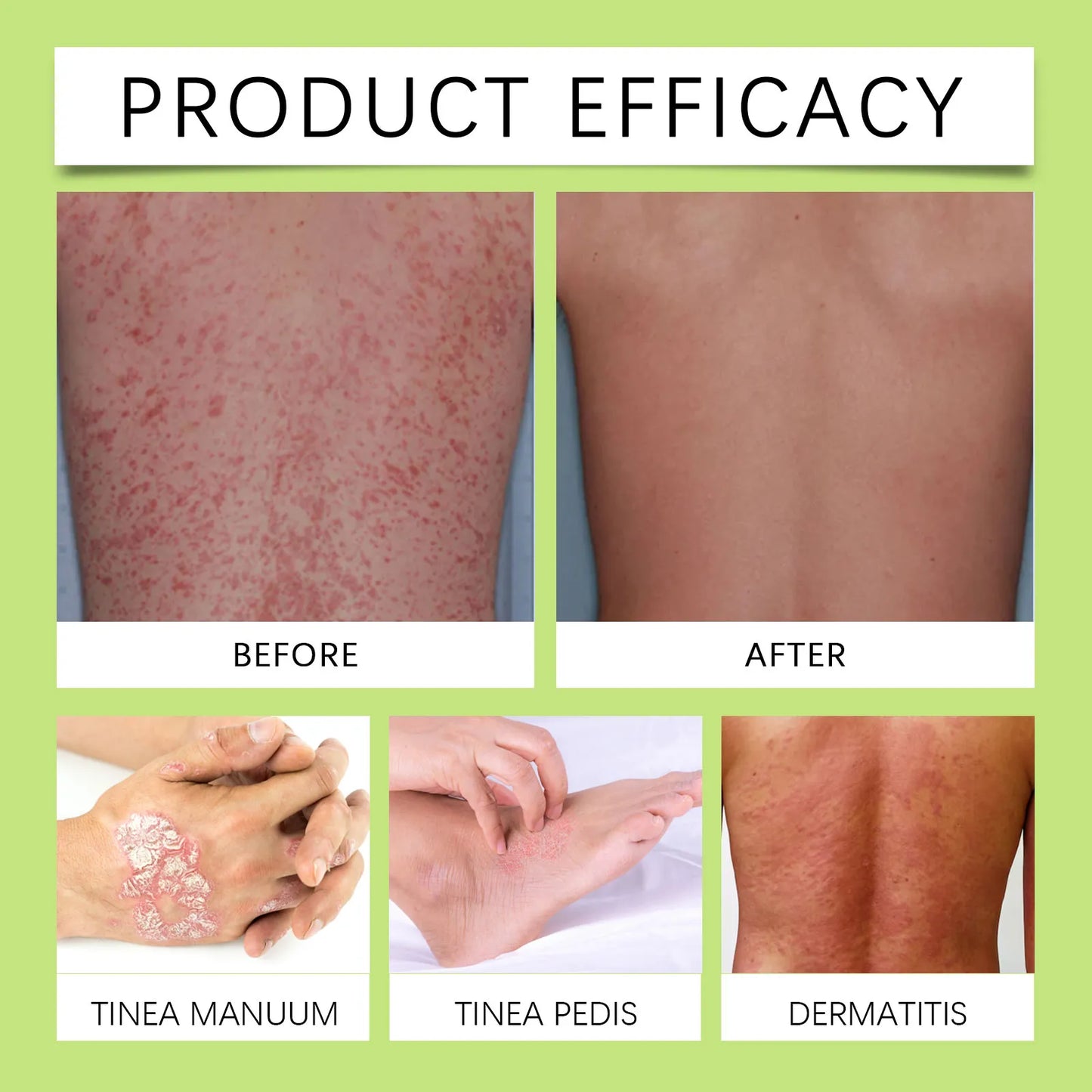 South Moon Psoriasis Moisturizing Cream ( BUY 1 GET 1 FREE )