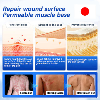 Imported japan Psoriasis Anti - Itch Spray