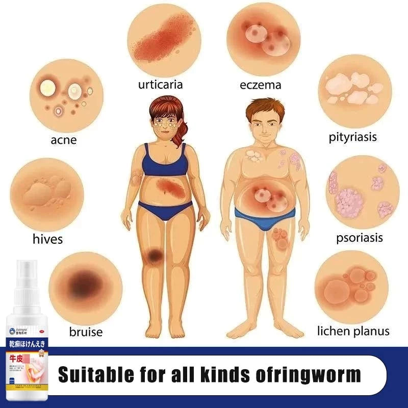 Imported japan Psoriasis Anti - Itch Spray