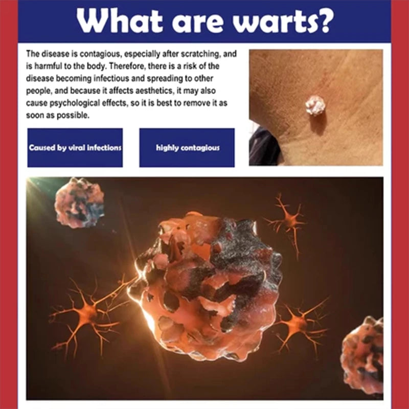 🌙🧴 South Moon Wart Care Cream – Removal & Skin Smoothing