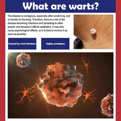 🌙🧴 South Moon Wart Care Cream – Removal & Skin Smoothing