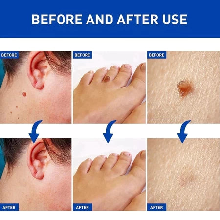 🌙🧴 South Moon Wart Care Cream – Removal & Skin Smoothing