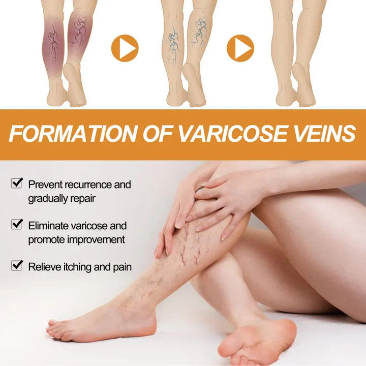 South Moon Varicose Veins Remover Cream ( BUY 1 GET 1 FREE )