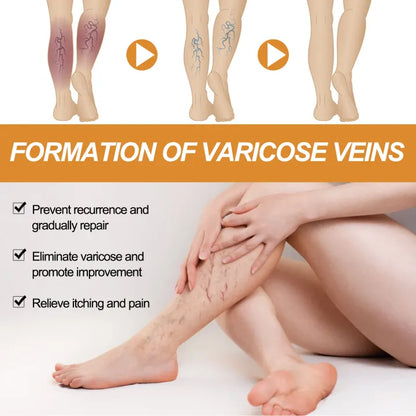 South Moon Varicose Veins Remover Cream ( BUY 1 GET 1 FREE )