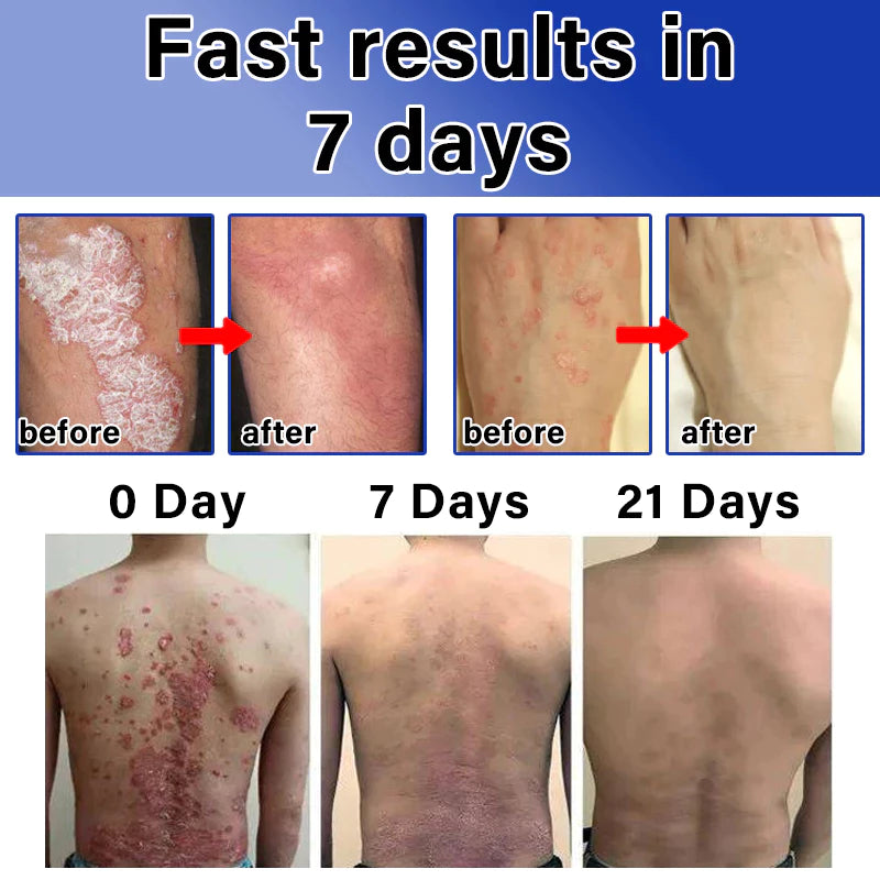 Japanese psoriasis spray ( BUY 1 GET 1 FREE )