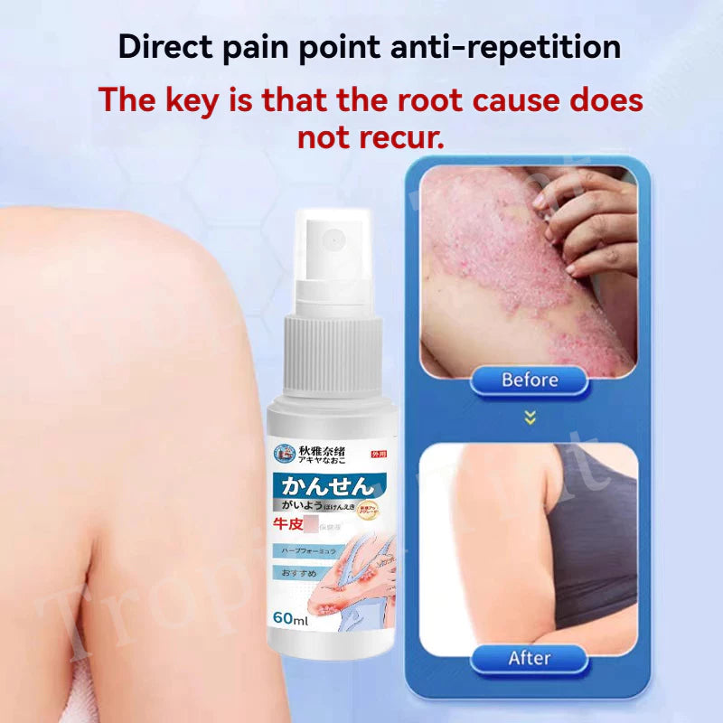 Japanese psoriasis spray ( BUY 1 GET 1 FREE )
