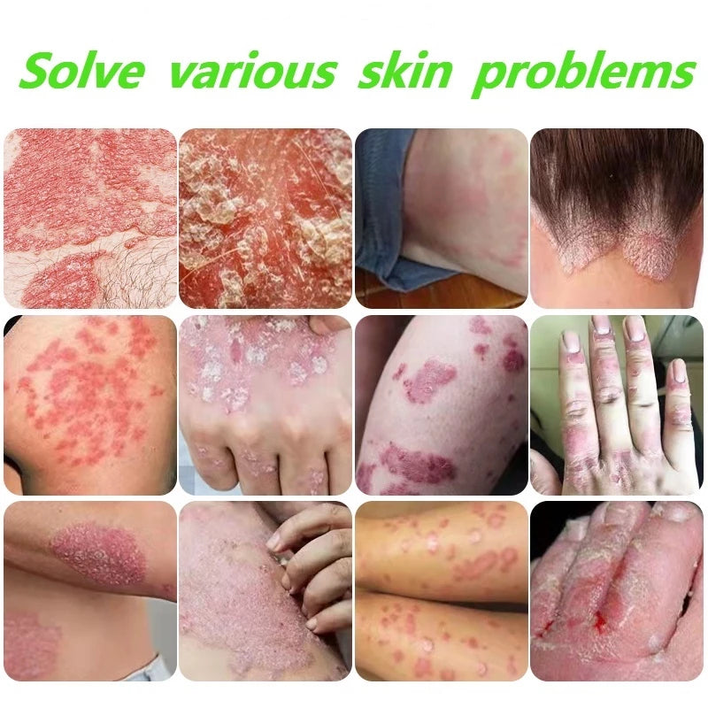 Japanese psoriasis spray ( BUY 1 GET 1 FREE )