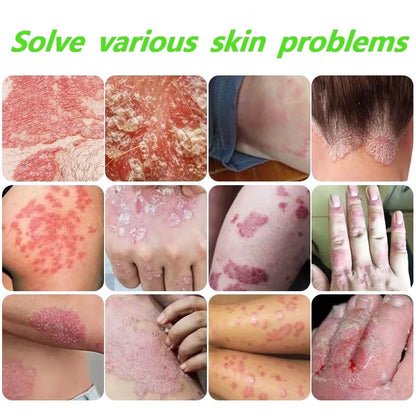 Japanese psoriasis spray ( BUY 1 GET 1 FREE )