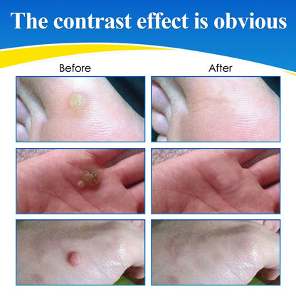 HEALMUSZ™ Wart Remover Liquid – Gentle Skin Renewal Solution