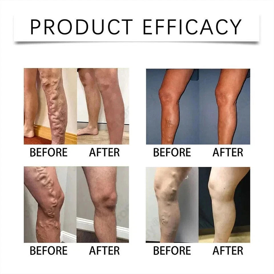 VeinEase™ Varicose Vein Microneedle Patch ( BUY 1 GET 1 FREE )